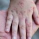 Alerta por aumento mundial de casos de sarampión